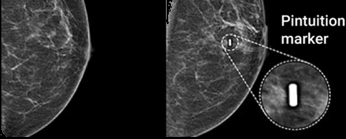 X-ray mammography — Pintuition marker localised on the mammogram.