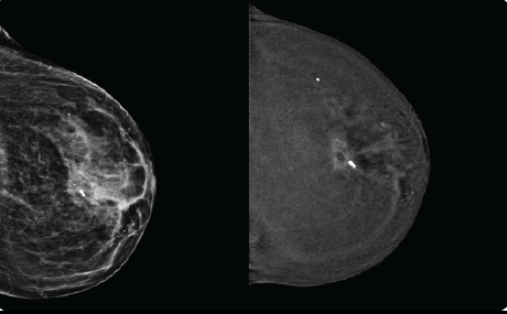 Contrast-enhanced mammography (CEM) post-deployment of the Pintuition marker — low-energy and recombined views showing the marker in situ.