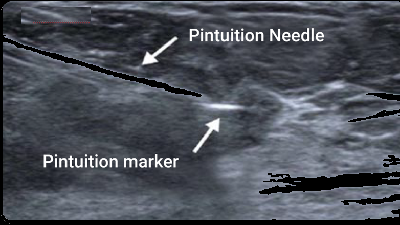 Ultrasound — the Pintuition needle and marker clearly labelled.