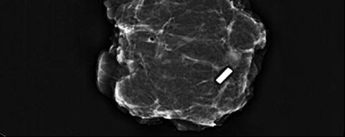 X-ray specimen radiograph — Pintuition marker confirmed within the excised specimen.