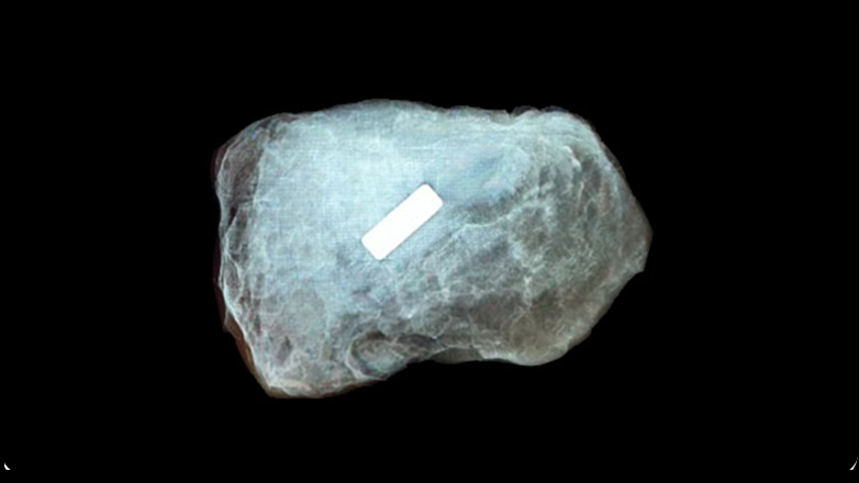 Axillary lymph node — Pintuition marker visible within the excised node.